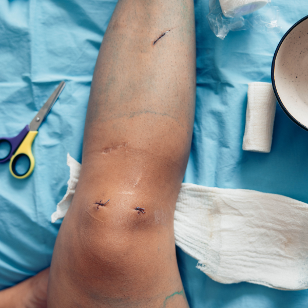 Factors affecting knee replacement recovery