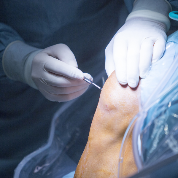 Knee arthroscopy procedure