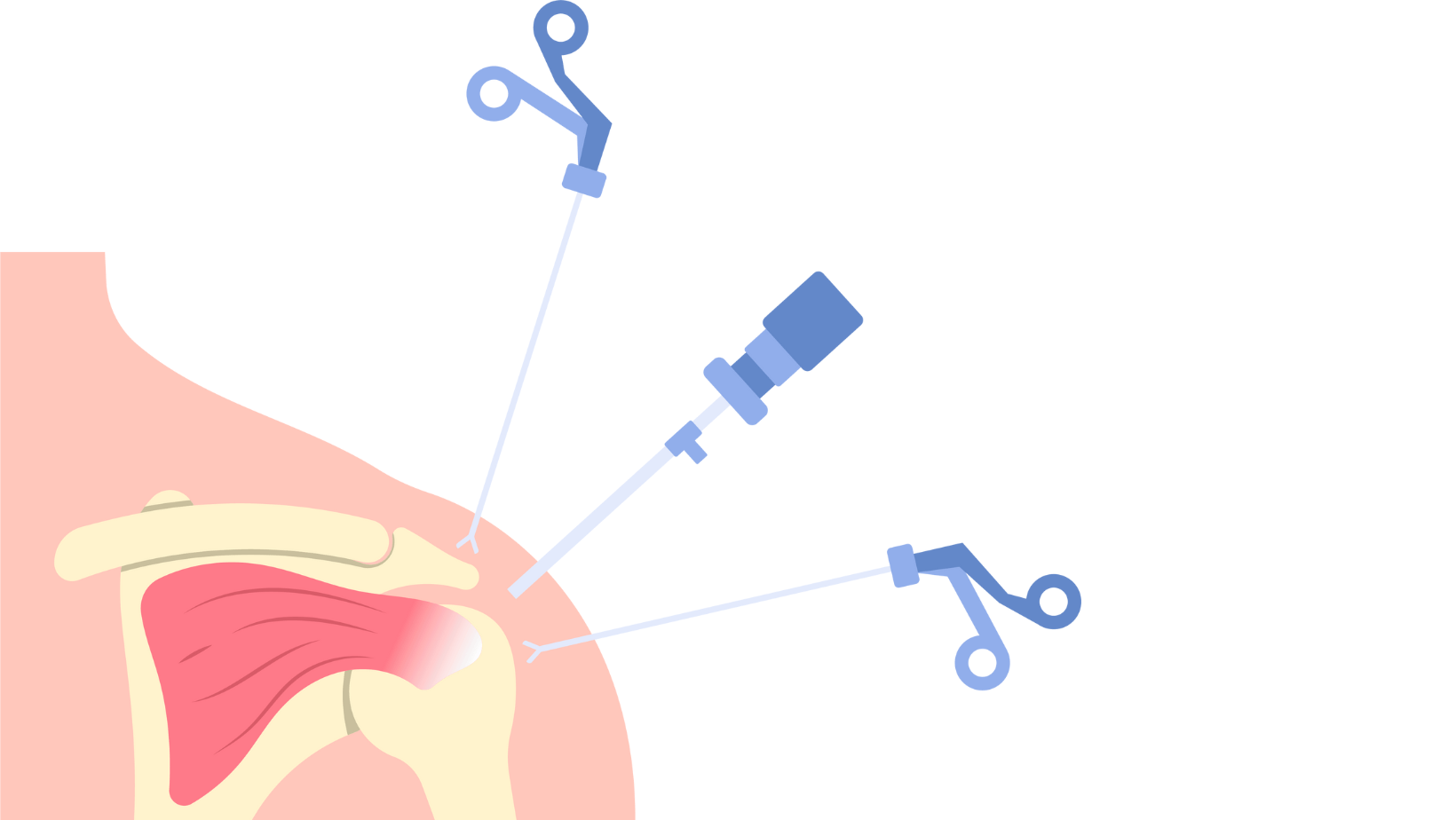Shoulder arthroscopy