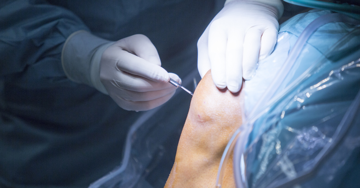 Endoscopy Spine Surgery illustration