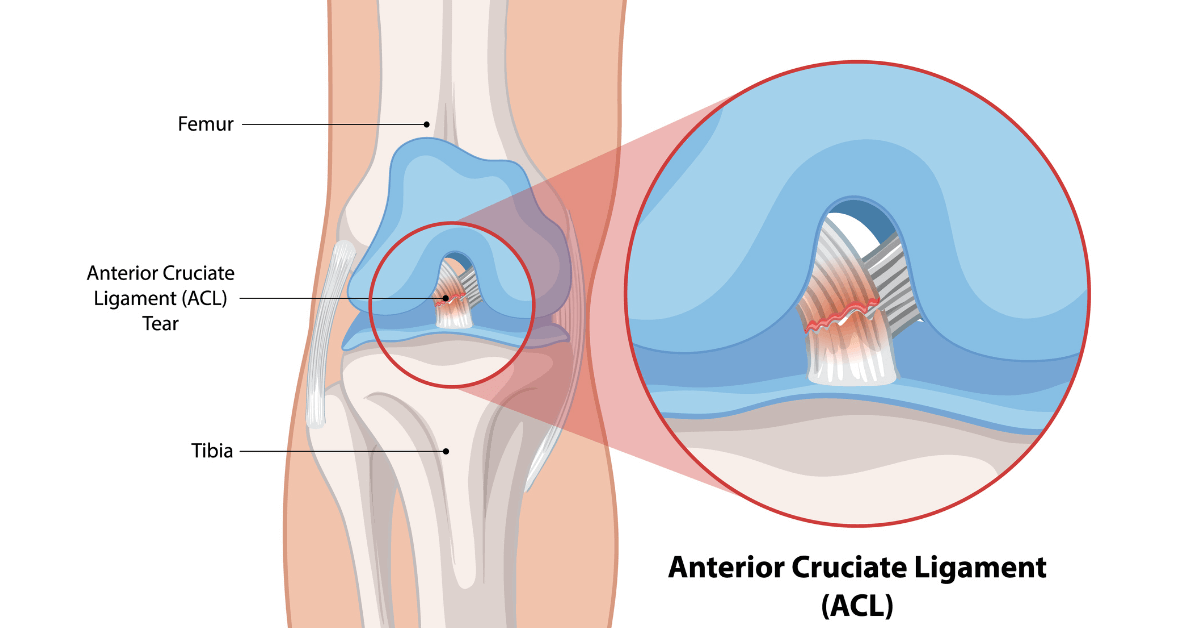 Anterior Cruciate Ligament