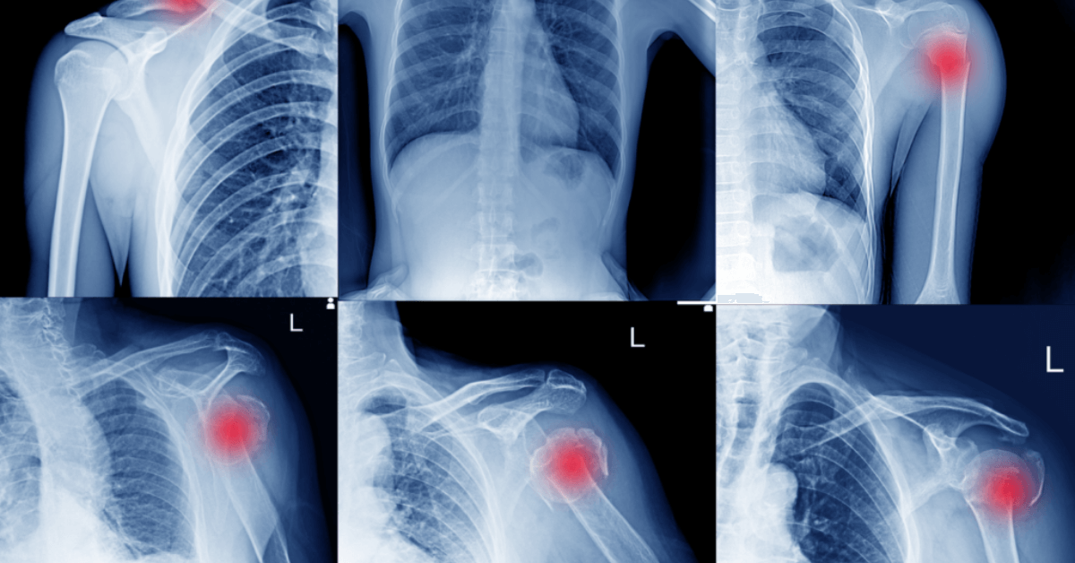 Shoulder Dislocation Treatment in Navi Mumbai