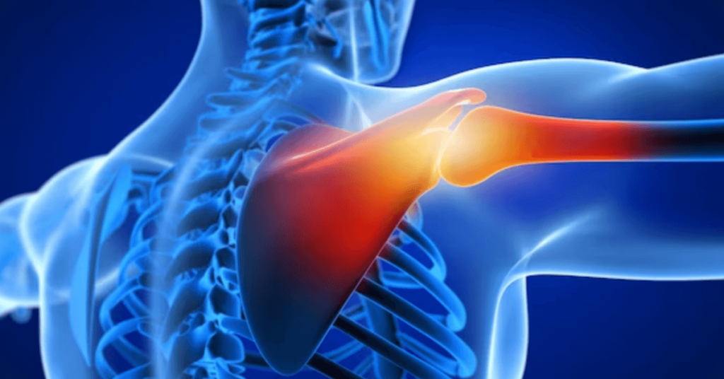 Shoulder Replacement