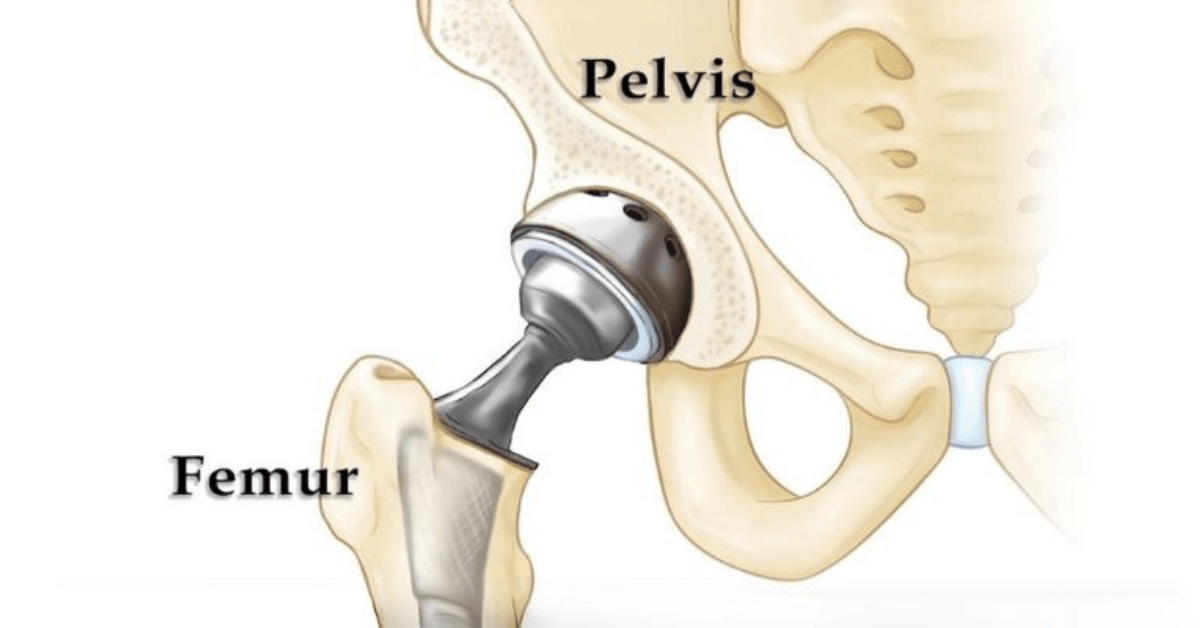 Total Hip Replacement In Kharghar
