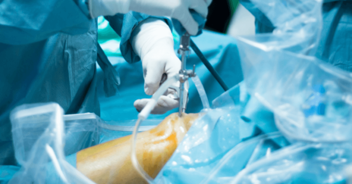 Arthroscopy Surgery