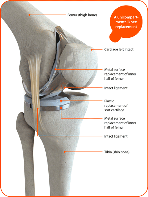 Robotic Knee Resurfacing in Navi Mumbai