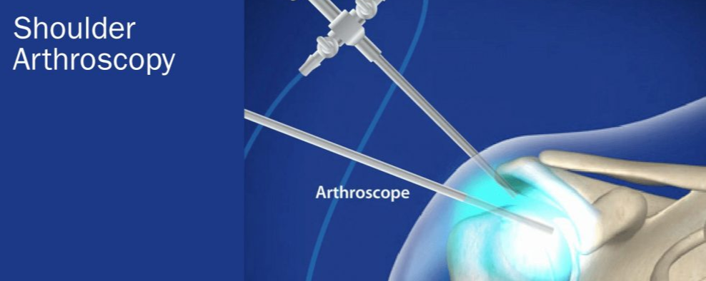 Shoulder arthroscopy